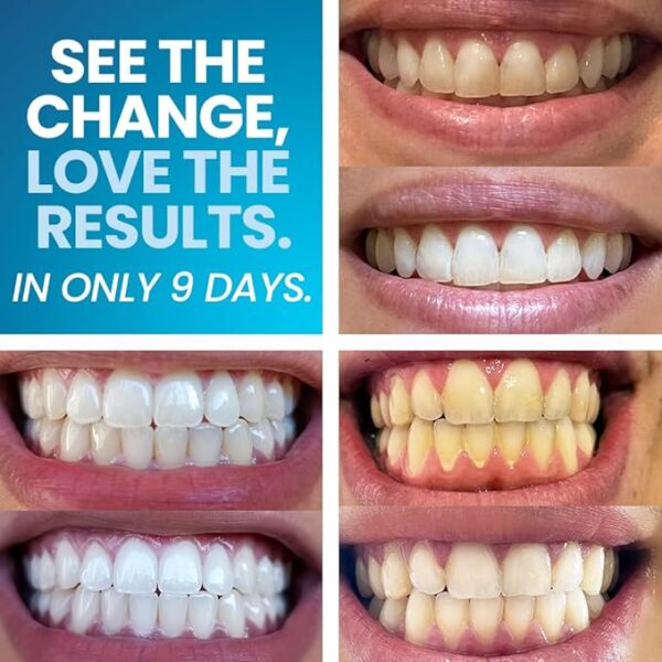 White Kit de blanqueamiento dental - Imagen 6